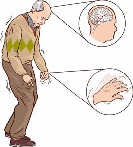 Illustration of a man experiencing physical difficulties with Parkinson's disease.