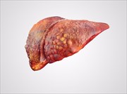 Liver Disease / Hepatic Disease