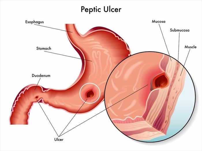 Peptic ulcer explained