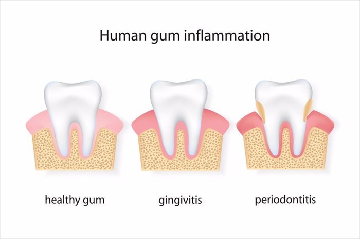 Gum disease progression