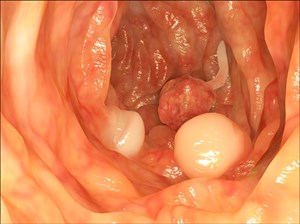 Diverticula in the colon.