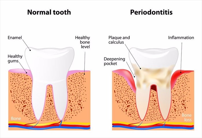 Gum disease illustrated