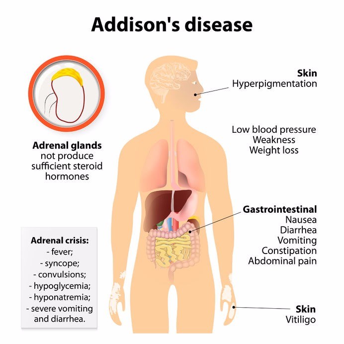Addison's disease explained