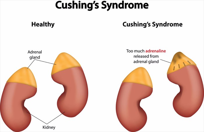Illustration showing the difference between normal and healthy adrenal glands.