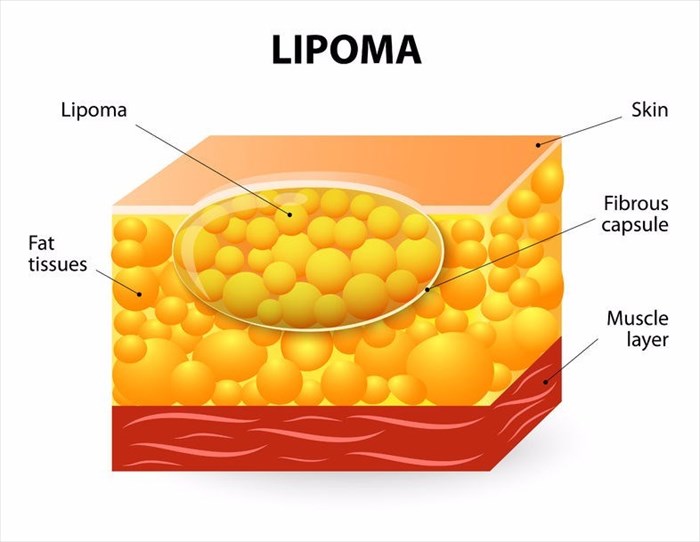 Diagram of a lipoma.