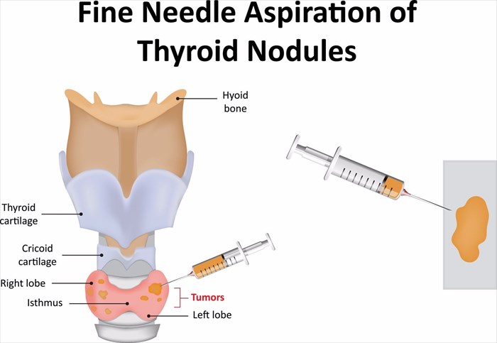 Illustration showing the testing procedure of fine needle aspiration of thyroid nodules.