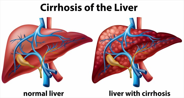 Illustration showing the difference between a healthy a cirrhotic liver (cirrhosis).