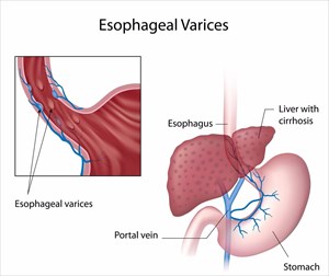 Illustration showing oesophageal varices.