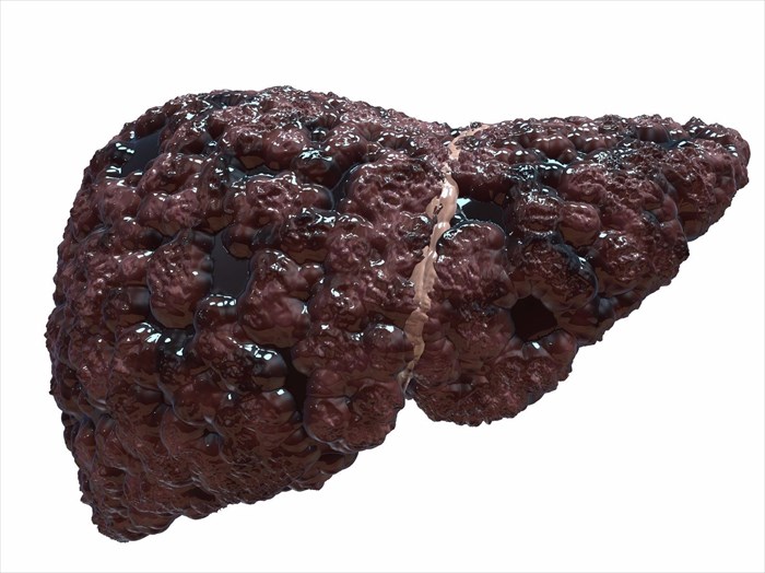 Advanced cirrhotic liver requiring a transplant.