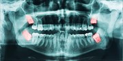Wisdom Teeth Removal / Impacted Tooth Extraction