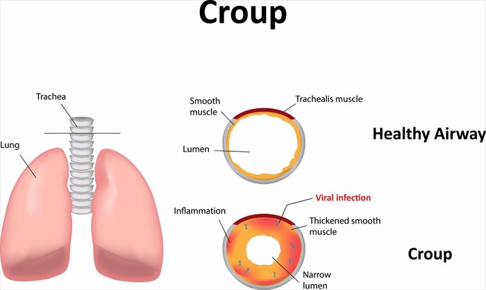 Illustration showing the difference between healthy airways and ones affected by croup.