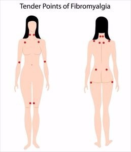 Fibromyalgia Trigger Points Illustration