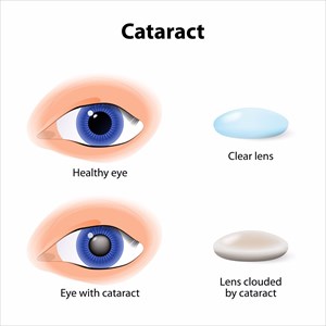 Illustration showing the difference between a healthy eye and one with a developed cataract (A cataract is an clouding crystalline lens inside the eye)
