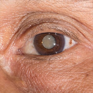 Close-up of a mature cataract during an eye examination.