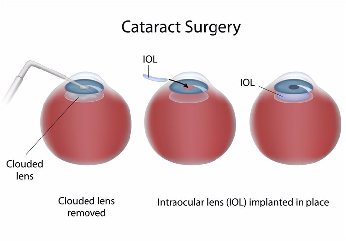 Illustration showing the basics of cataract removal and IOL implant surgery.