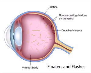 Illustration depicting retinal detachment (floaters and flashes).