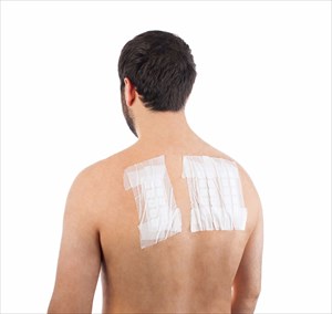 Skin allergy patch test on the back of a male patient.