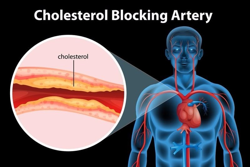 Blood type and cardiovascular disease heart disease 