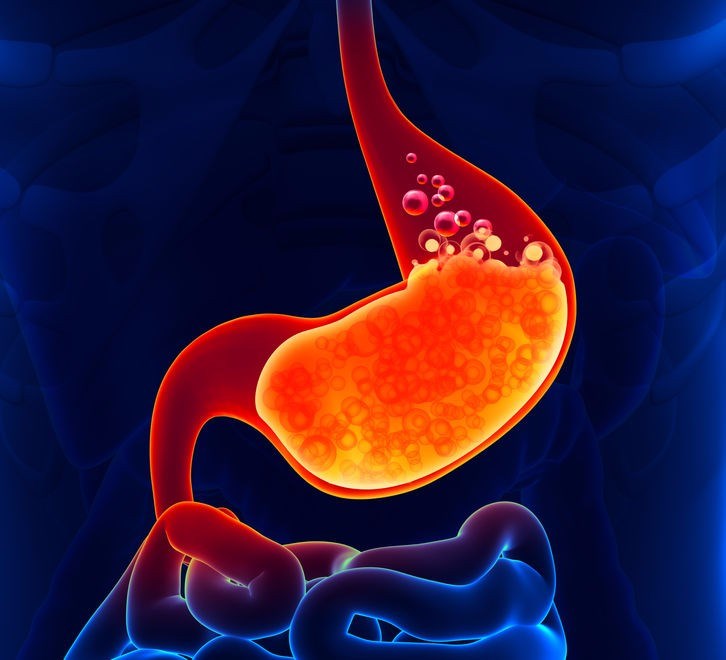 What causes acid reflux (GERD)?