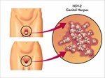 Genital herpes symptoms