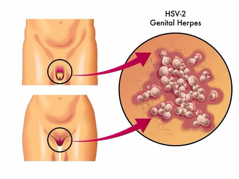 Herpes genitalis ist was Informationen über