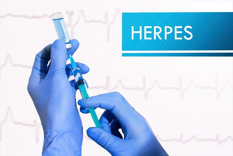 Genital Herpes Faqs