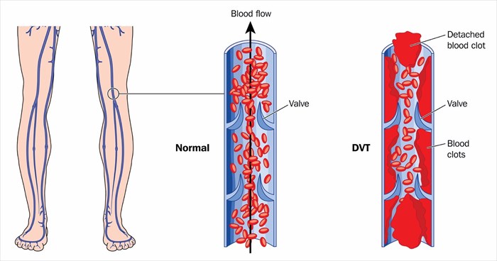 Drawing showing deep vein thrombosis in the leg veins.