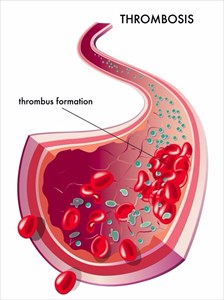 Thrombosis illustration showing the formation and breaking apart of a blood clot.