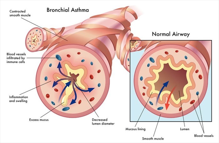 Bronchitis and Asthma: Understanding the Connection