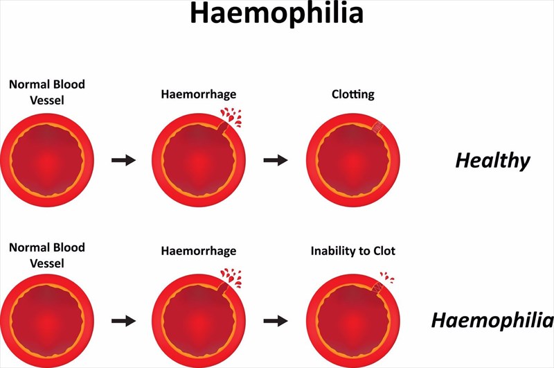 Types and causes of blood clots