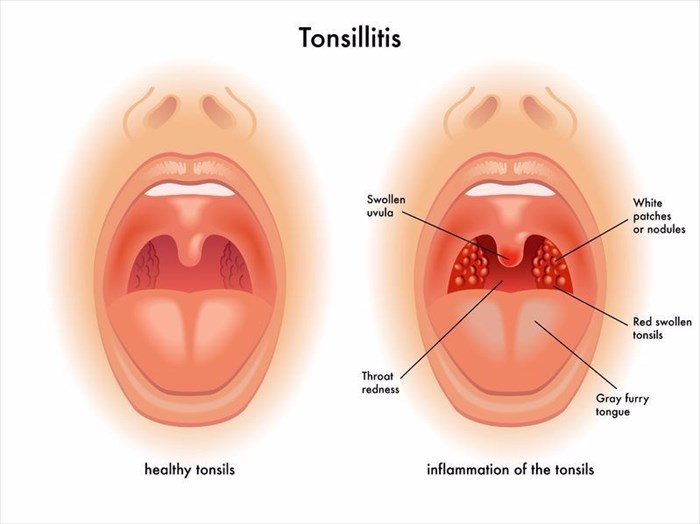 Illustration of tonsillitis 