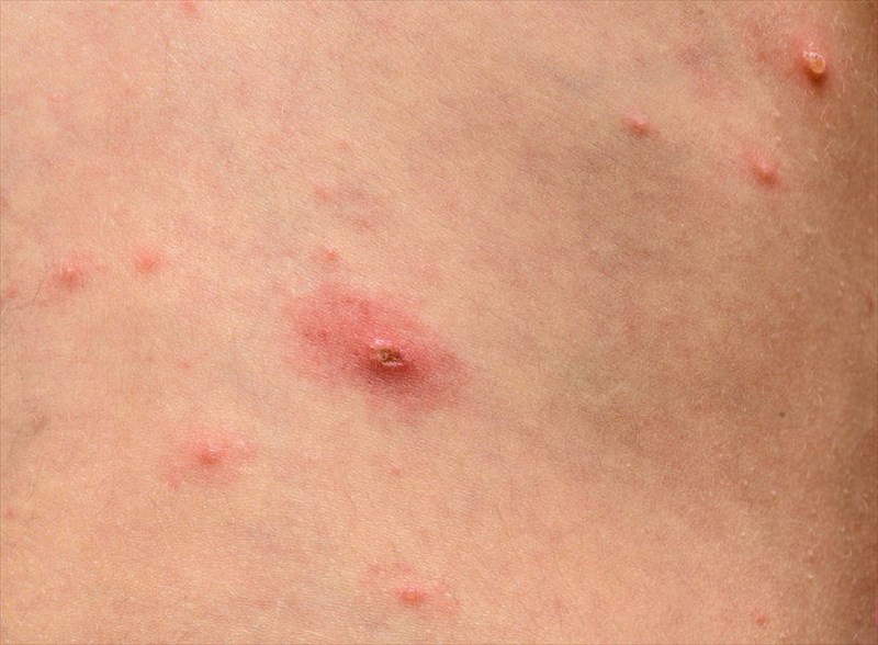 Signs and symptoms of chickenpox