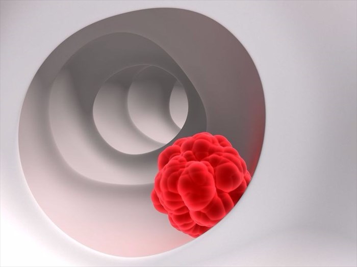 Colon cancer