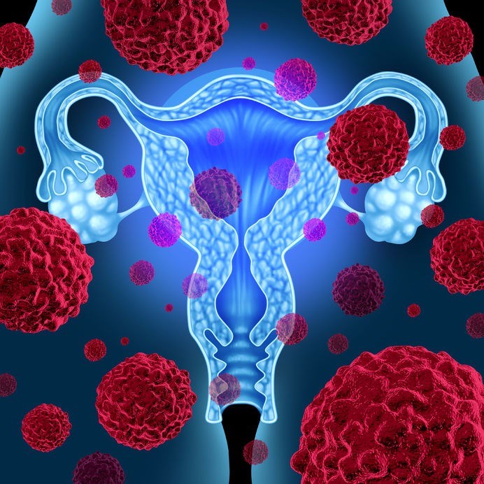 Uterine cancer