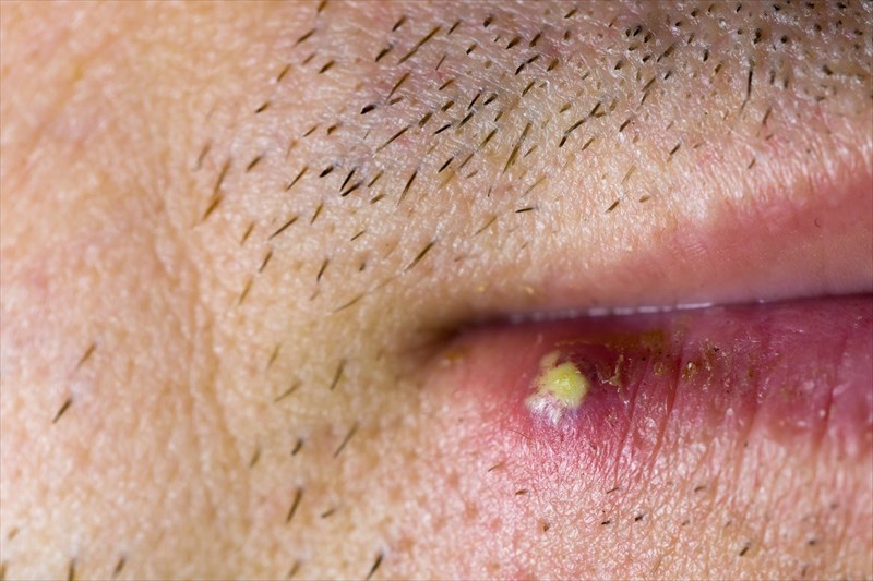 Herpes Faqs