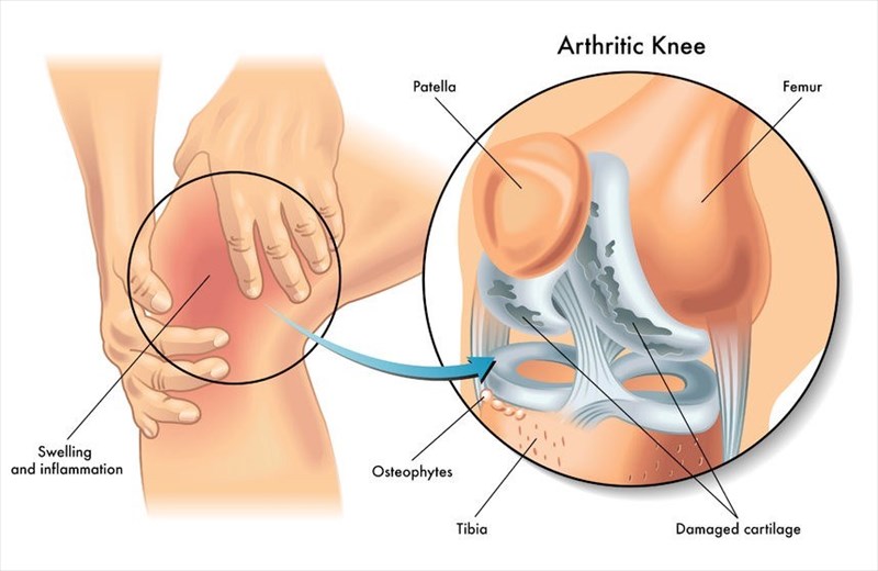 Types of arthritis