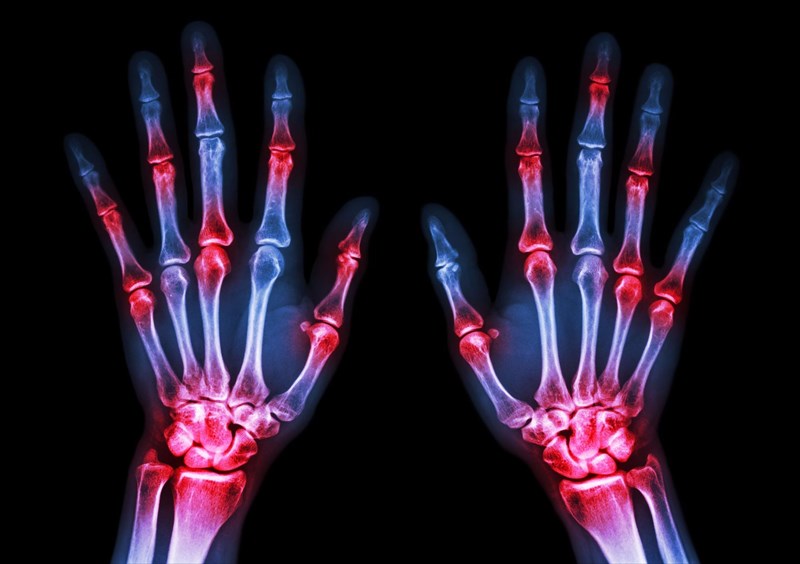 What causes arthritis?