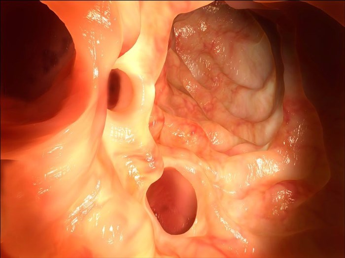 Diverticula in the colon, seen through an endoscope.