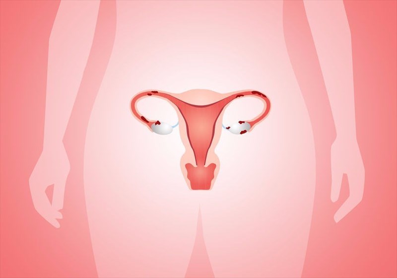 FAQ about endometriosis