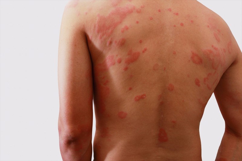 Got heat rash? Here's how to identify and treat the condition - Etre Vous