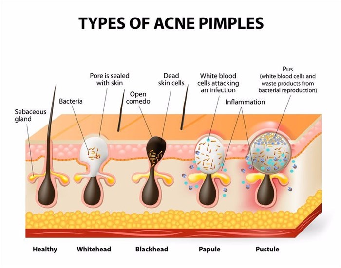 Types of acne.