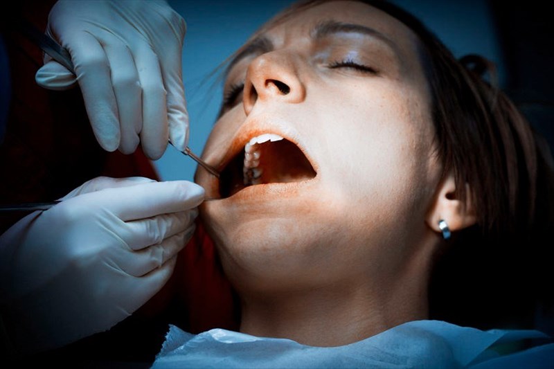 What are the stages of periodontitis?