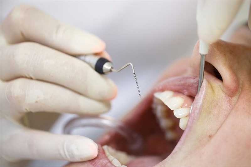 What are the different types of periodontitis?