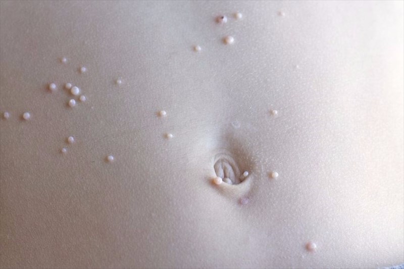 What are the symptoms of molluscum contagiosum?
