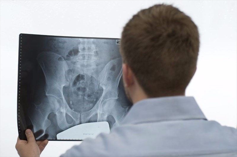 What are the different types of osteoporosis?