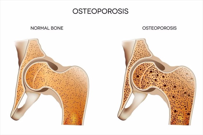 Osteoporosis effect on bone