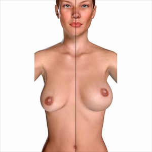 Diagram of young woman, before and after breast augmentation and lift.