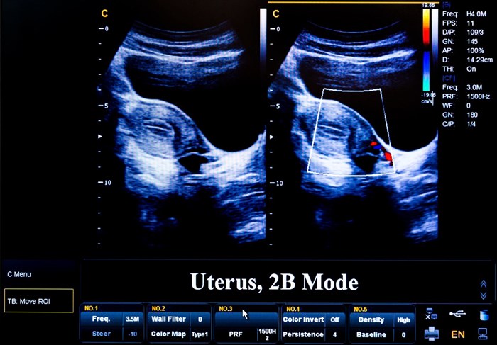 Two-dimensional (2-D) ultrasound scan example.