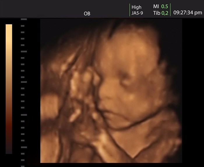 Example of a three-dimensional (3-D) ultrasound scan showing an unborn baby in a woman's uterus (womb).