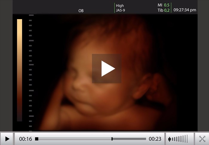 Example of a four-dimensional (4-D) ultrasound scan showing movement of an unborn baby in a woman's uterus (womb).